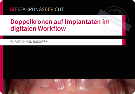 Ein Beitrag über den vollständig digitalen Workflow zur Herstellung von Doppelkronen auf Implantaten.